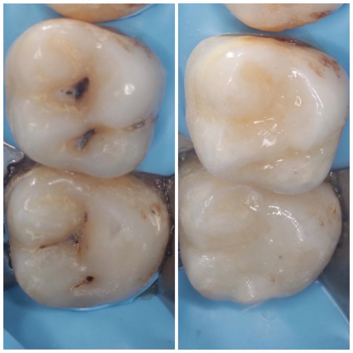 a_sa_dent's tweet photo. Direct composite restoration 
حشوات تجميلية 
#kku
#kku_dent 
#Restoration 
#rubber_dam
For more photos and details 

https://t.co/S6RNFFj9Zo https://t.co/kqXpWc966h