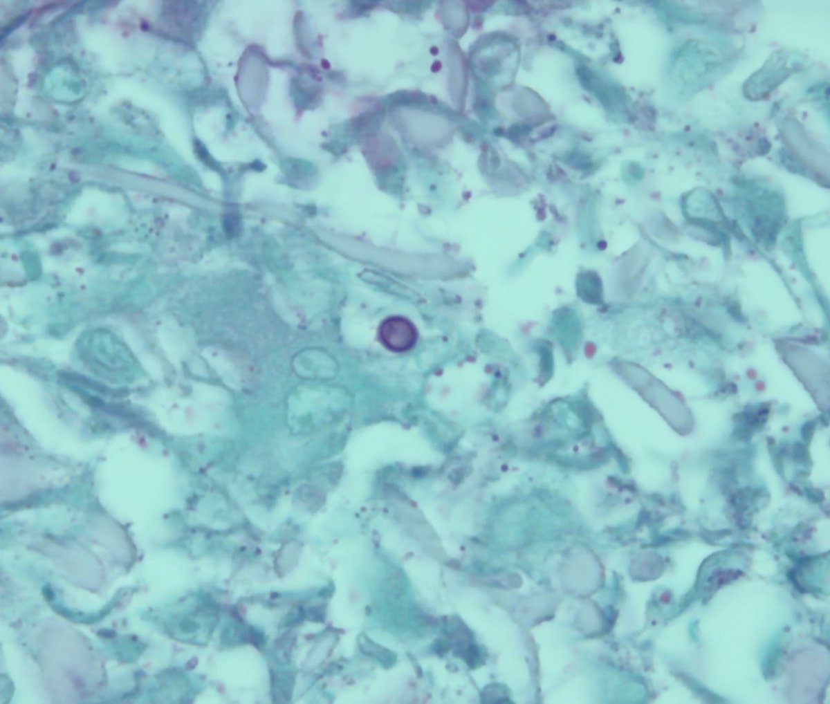 Dartmouth Health Infectious Disease Fellowship (@DartmouthID) on Twitter photo 2022-09-14 16:48:28 1/2 #IDclinicalcase: 64M from northern NH, w/PMHx of prostate CA, Crohn’s disease on infliximab presents to the clinic with 1-year history of non-healing ulcers on his upper extremity.(Consent obtained to share images) Biopsy+culture obtained #IDtwitter #IDboardreview #MedTwitter 1/2 #IDclinicalcase: 64M from northern NH, w/PMHx of prostate CA, Crohn’s disease on infliximab presents to the clinic with 1-year history of non-healing ulcers on his upper extremity.(Consent obtained to share images) Biopsy+culture obtained #IDtwitter #IDboardreview #MedTwitter