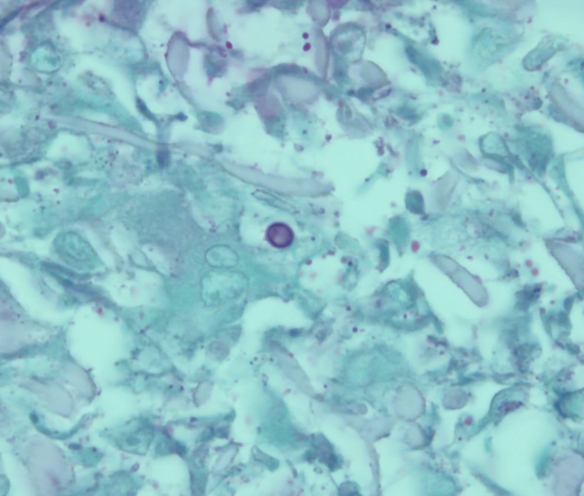 1/2 #IDclinicalcase: 64M from northern NH, w/PMHx of prostate CA, Crohn’s disease on infliximab presents to the clinic with 1-year history of non-healing ulcers on his upper extremity.(Consent obtained to share images) Biopsy+culture obtained #IDtwitter #IDboardreview #MedTwitter