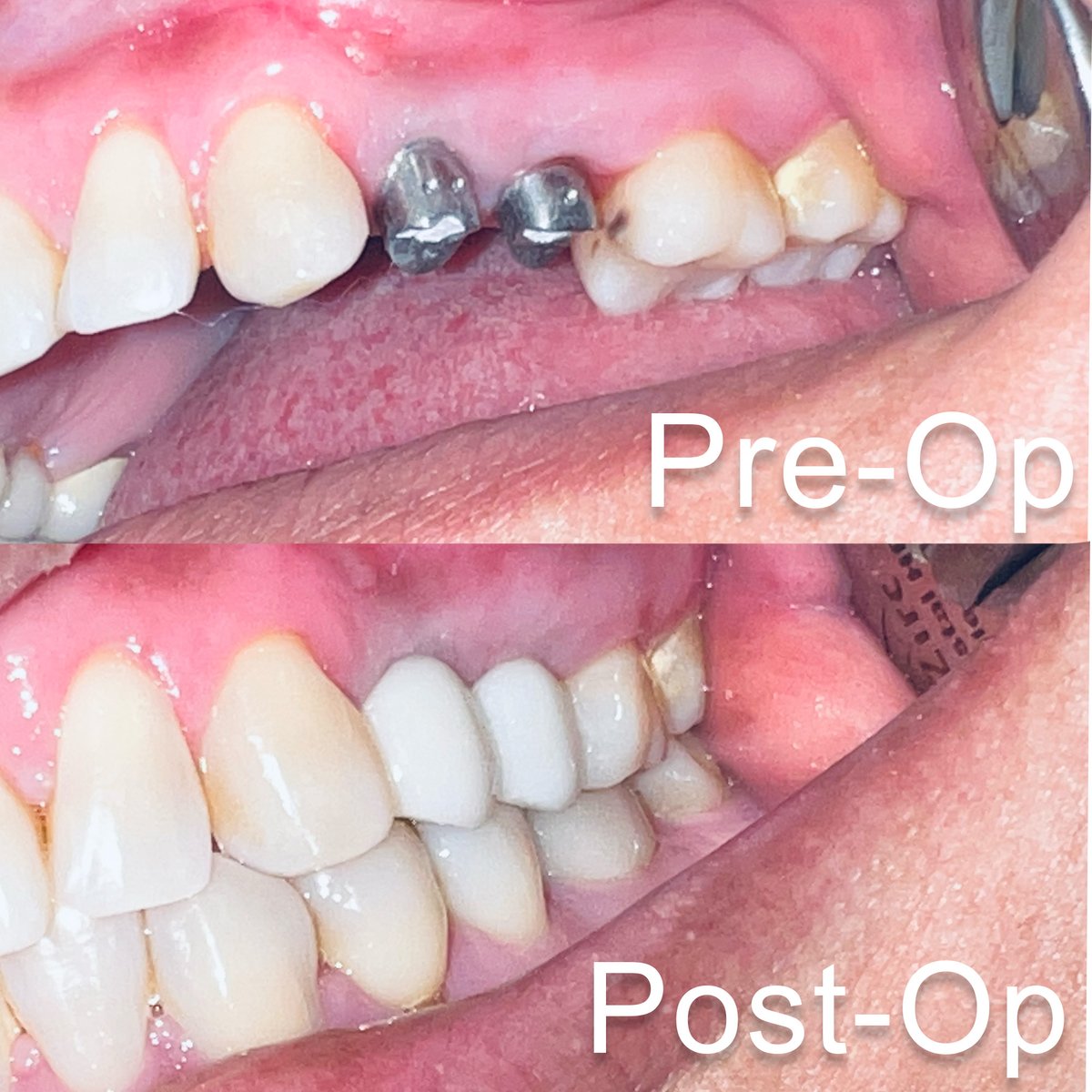 cdic_dmd's tweet photo. Juana came to the office with missing 12 &amp; 13 teeth. We rehabilitated this area with implant retained crowns. It took a total of 3 months to complete. 

Look at these stunning results!

#dentistry #charlotte_dentist #RameshSunar #DrRush #cosmeticdentist #affordable_Implants https://t.co/Qgh6LHvhbF