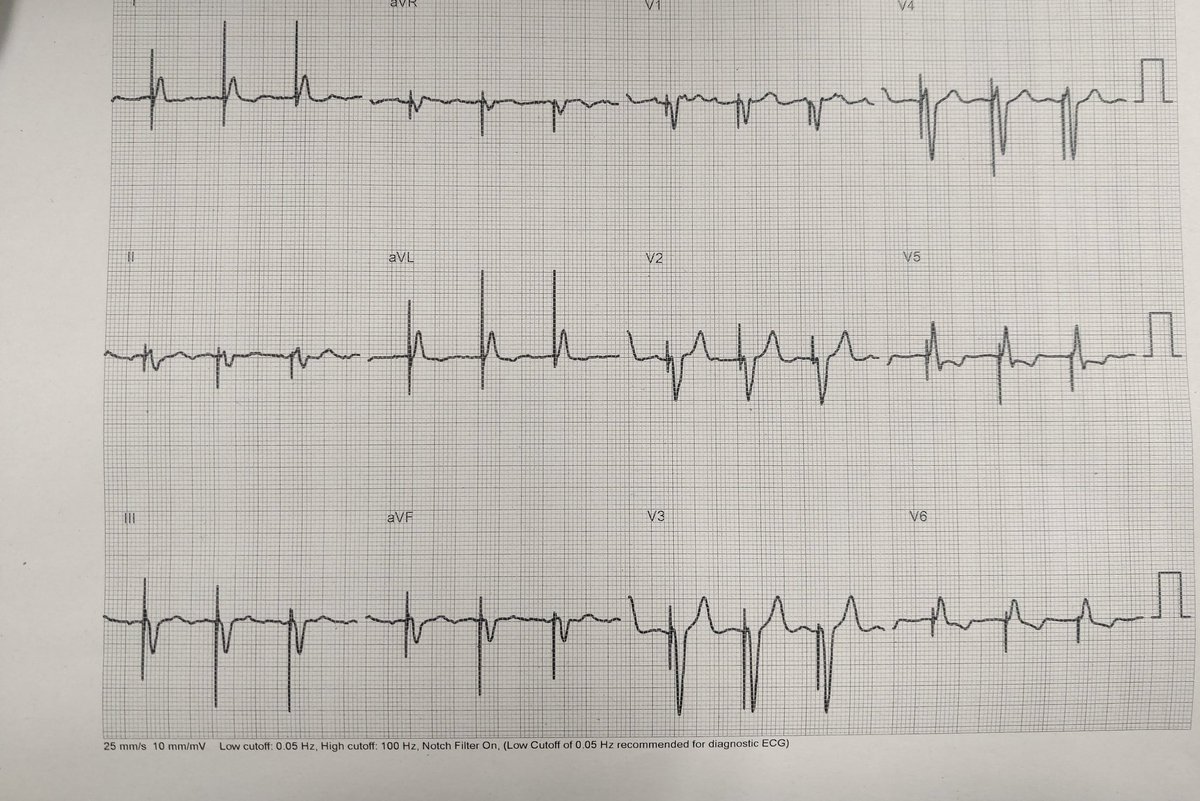 Rafael Raso Raso (@rasocardio) on Twitter photo Hoy en <a href="/cardioalcoi/">Unidad de Cardiología Hospital de Alcoi</a> dos marcapasos con estimulación en región de rama izquierda. Contento de poder ofrecer a los pacientes del @GVAdsalcoi los últimos avances en estimulación. <a href="/RadioAlcoy/">Radio Alcoy</a> <a href="/NostreCiutat/">ElnostreCiutat</a> <a href="/SVCardio/">SVCardio</a> <a href="/secardiologia/">Soc Esp Cardiología</a> Hoy en <a href="/cardioalcoi/">Unidad de Cardiología Hospital de Alcoi</a> dos marcapasos con estimulación en región de rama izquierda. Contento de poder ofrecer a los pacientes del @GVAdsalcoi los últimos avances en estimulación. <a href="/RadioAlcoy/">Radio Alcoy</a> <a href="/NostreCiutat/">ElnostreCiutat</a> <a href="/SVCardio/">SVCardio</a> <a href="/secardiologia/">Soc Esp Cardiología</a>