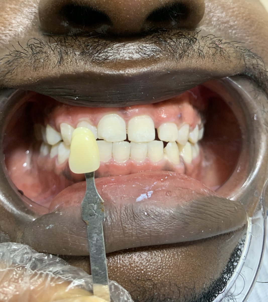 Yanga Dental Clinic on Twitter "The way to WHITEN Your