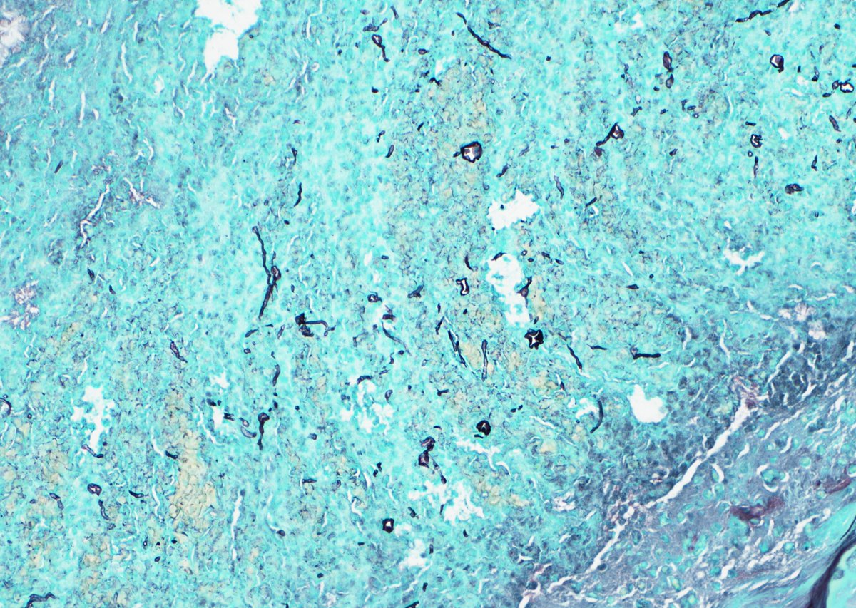 NHardy_path's tweet photo. Classic "allergic mucin" – alternating red and blue waves of eosinophils and inflammatory debris (the hallmark of allergic fungal sinusitis) w/ hyphal forms highlighted by GMS (only in the free-floating mucin). Many Charcot-Leyden crystals from degenerating eos (last pic). https://t.co/im92oxN09V