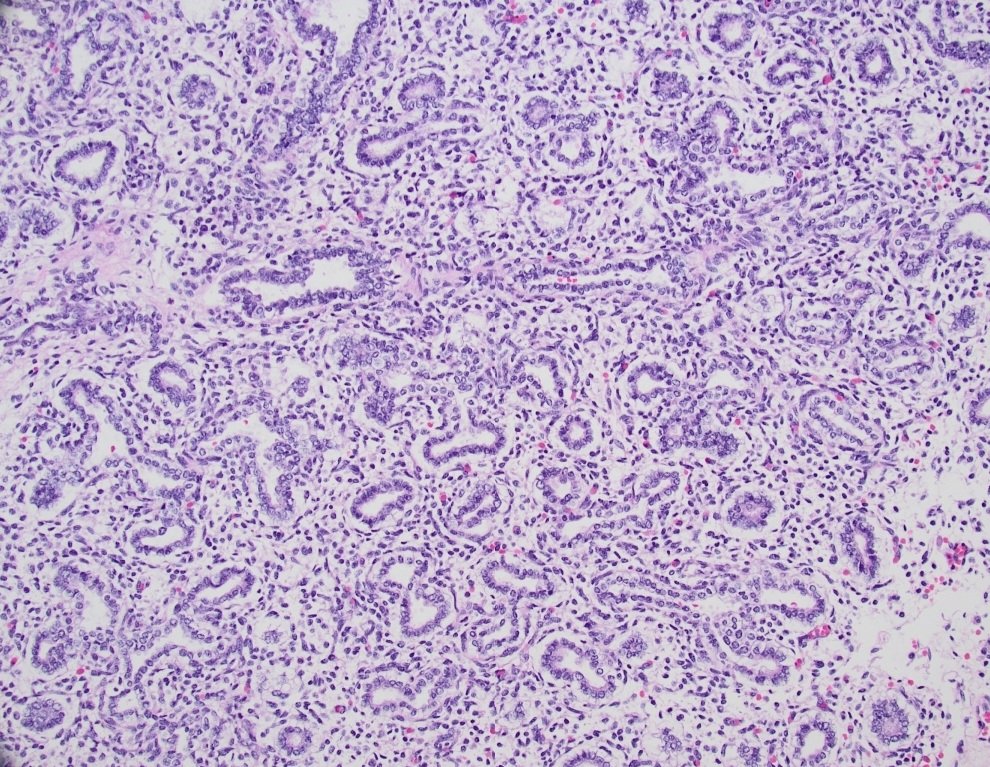 For pathology residents or interested medical students:
Lungs from a previable fetus of unknown gestational age. What stage of pulmonary development would you say it is?
#pedspath #perinatalpath #pathtwitter #cgch