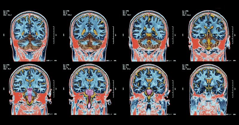HMethodistMD's tweet photo. Houston Methodist, Rice University and Baylor College of Medicine to develop sleeping cap that helps the brain clear metabolic waste and improve sleep in real time. Long-term it could delay neurodegenerative disease.  #sleepdisorders #neuroregenerativedisease