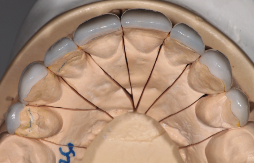 InDentalTech's tweet photo. In case you missed it! #MasterClassFlashback: “No-Prep Veneers” by Zachary S. Sisler, DDS; and Juan Rego, CDT, FAACD https://t.co/0LwziNuGrS https://t.co/8dr4J8iIJg
