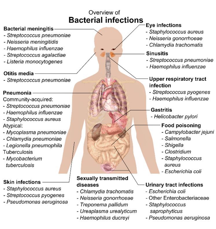 Innov_Medicine's tweet photo. Overview of bacterial infections at a glance
#MedEd #MedTwitter https://t.co/IK4SSzx1BY