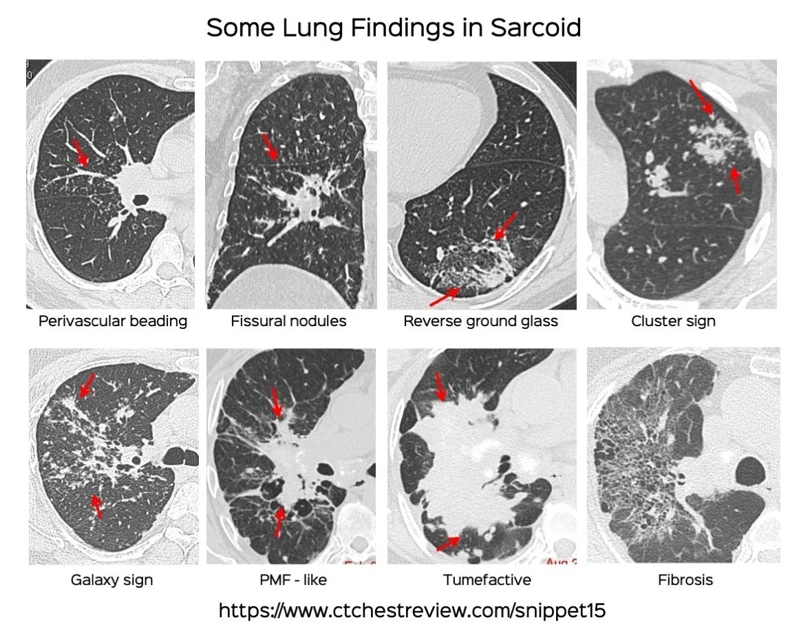 CT Scan Findings in Sarcoidosis Some typical and atypical lung findings in sarcoidosis Video and post ctchestreview.com/snippet15/ #chestrad #ctchest #FOAMrad #radres #lung #mediastinum #lymphadenopathy #sarcoidosis