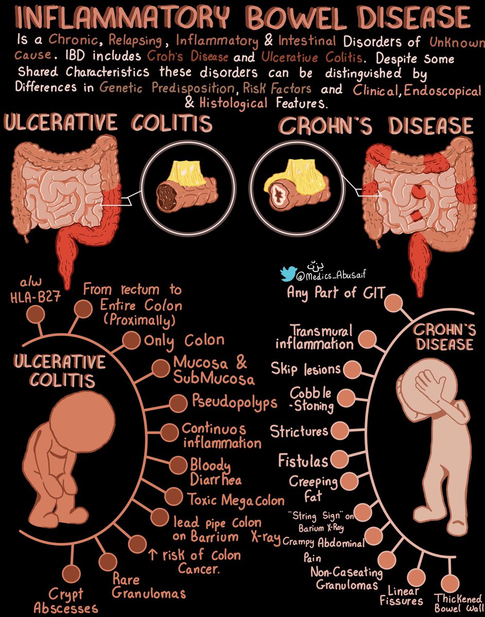 Paul_Wischmeyer's tweet image. 🙋‍♂️ Differences between Ulcerative Colitis &amp;amp; Crohns Disease
#MedEd #MedTwitter #FOAMed

H/T @medics_AbuSaif