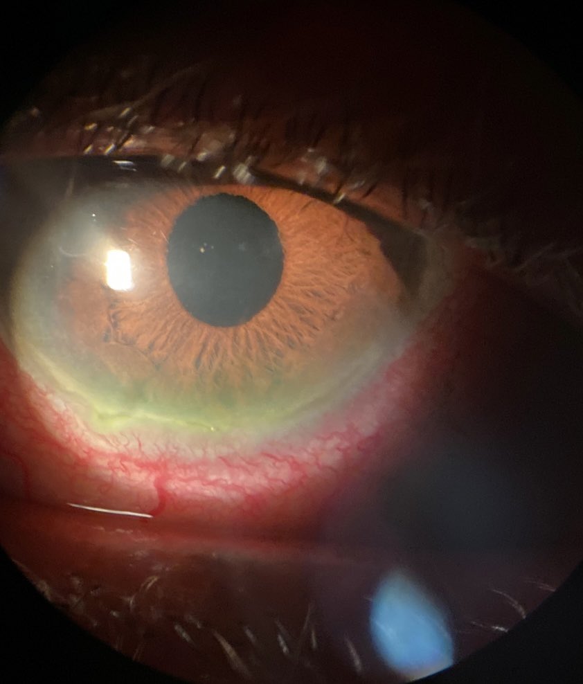 thecorneaMD's tweet photo. Peripheral ulcerative keratitis
- sent for inflammatory lab work
-started patient on prednisone PO

#rheumatology #cornea @ACRheum @CornealPhys_Mag https://t.co/IQI4Q4EVZh
