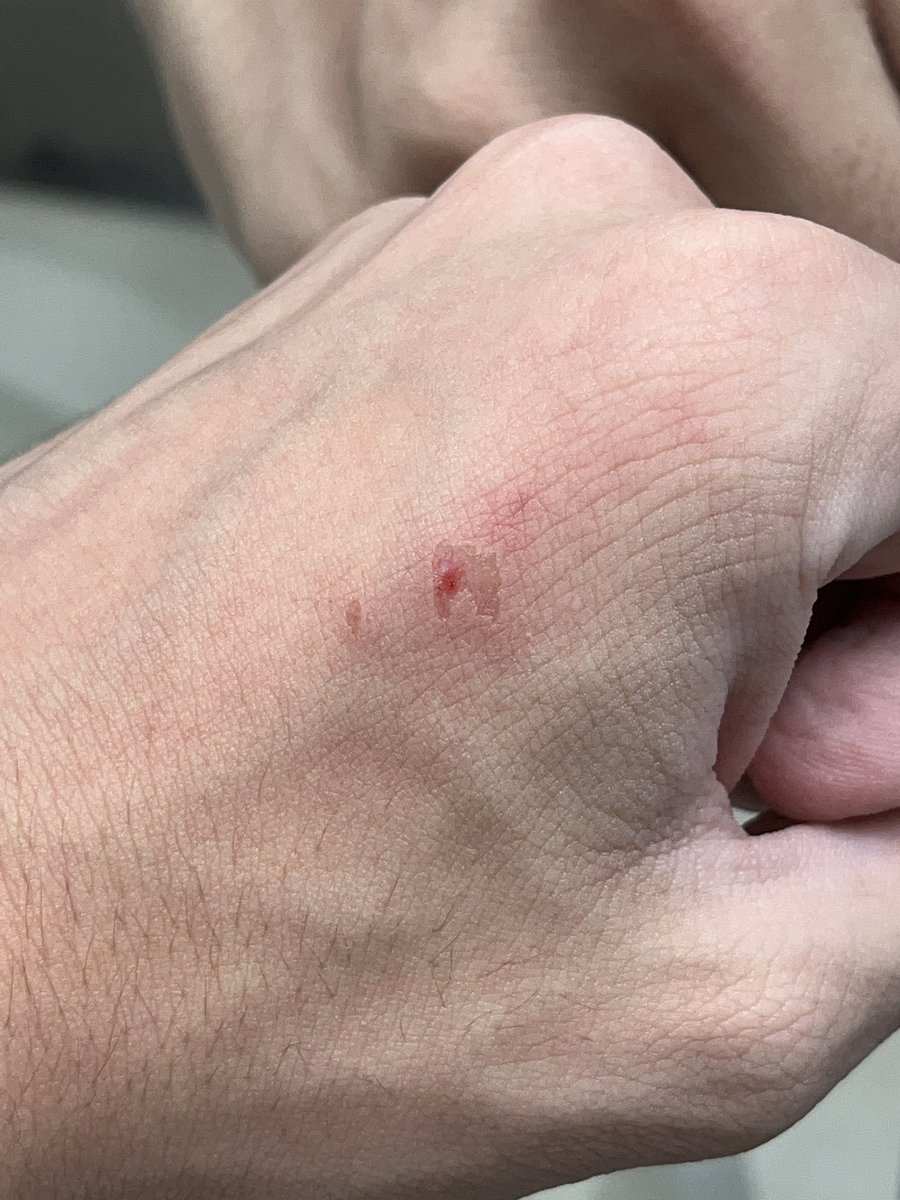 i swear to god i’m gonna do things to myself that i can’t say on twitter. no way i got an among us shaped scratch on my hand i hate this world