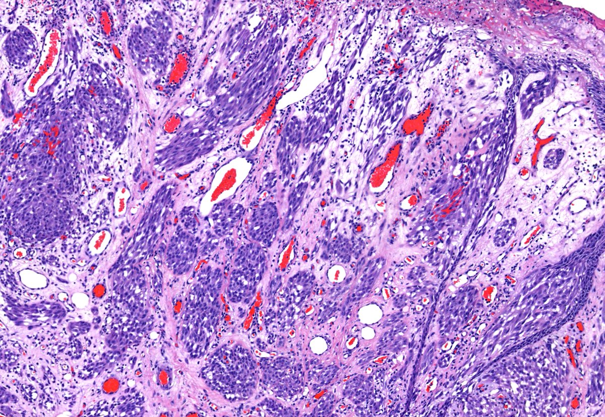 Confused by all the different Spitz nevus fusions?  Wouldn't it be great to see them altogether with one of the world's foremost experts?  See the <a href="/mccalmo/">Tim McCalmont</a> fuseroma collection here: kikoxp.com/posts/13626 #dermpath #DermTwitter #PathTwitter #MedEd #Spitz