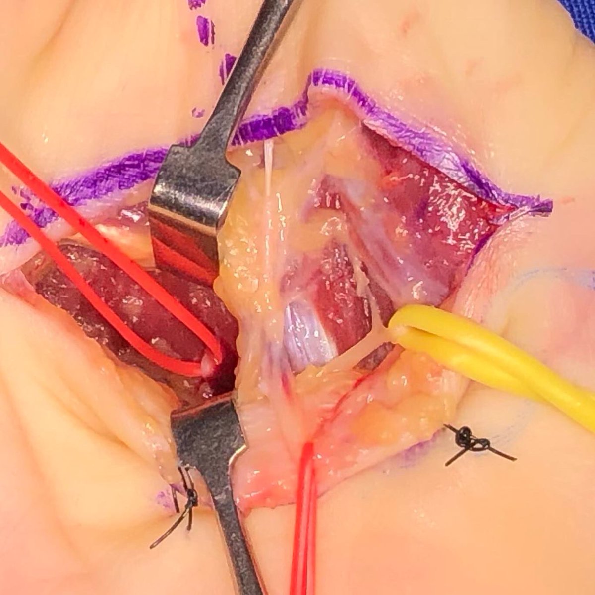 Christopher J. Dy MD MPH FACS tweet media