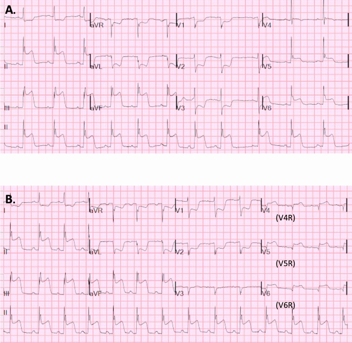 RCMjournal's tweet photo. #RCM - Special Issue: State-of-the-Art Cardiovascular Medicine in Europe 2022 (4/10)

🫀 Right ventricular myocardial infarction: pathophysiology, clinical implications and management

#RVMI #RCA #LAD #ACS #rightventricular #RV #management #MI

Full text:
https://t.co/xjZJnERFOQ https://t.co/ilCWy3dUCR