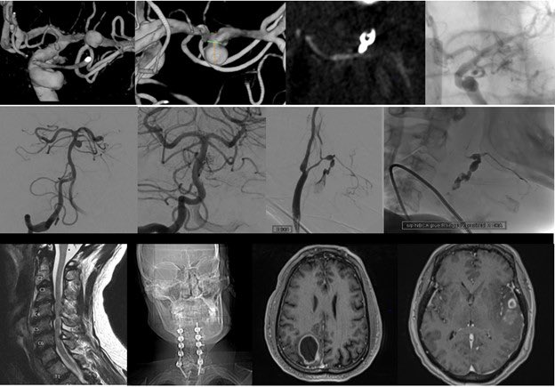 Rizwan Tahir (@riztahirmd) on Twitter photo A great start to my career <a href="/MedStarWHC/">MedStar Washington</a>. Great colleagues, amazing residents <a href="/MGUHNeurosurg/">Georgetown/WHC Neurosurgery</a> <a href="/edowlati/">Ehsan Dowlati, MD</a>. Cannot thank my mentors enough for 9 years of training! <a href="/HenryFordNeuro/">Henry Ford Neuroscience</a> <a href="/SteveKalkanisMD/">Steven N. Kalkanis MD</a> <a href="/PascalJabbourMD/">Pascal Jabbour MD, FAANS, FACS, FAHA</a> <a href="/StavTjoumakaris/">Stavropoula Tjoumakaris MD, MBA, FAANS, FACS, FAHA</a> <a href="/ReidGooch/">Reid Gooch</a> <a href="/DrFadyCharbel/">Dr. Fady Charbel</a>. #neurosurgery #medicine A great start to my career <a href="/MedStarWHC/">MedStar Washington</a>. Great colleagues, amazing residents <a href="/MGUHNeurosurg/">Georgetown/WHC Neurosurgery</a> <a href="/edowlati/">Ehsan Dowlati, MD</a>. Cannot thank my mentors enough for 9 years of training! <a href="/HenryFordNeuro/">Henry Ford Neuroscience</a> <a href="/SteveKalkanisMD/">Steven N. Kalkanis MD</a> <a href="/PascalJabbourMD/">Pascal Jabbour MD, FAANS, FACS, FAHA</a> <a href="/StavTjoumakaris/">Stavropoula Tjoumakaris MD, MBA, FAANS, FACS, FAHA</a> <a href="/ReidGooch/">Reid Gooch</a> <a href="/DrFadyCharbel/">Dr. Fady Charbel</a>. #neurosurgery #medicine