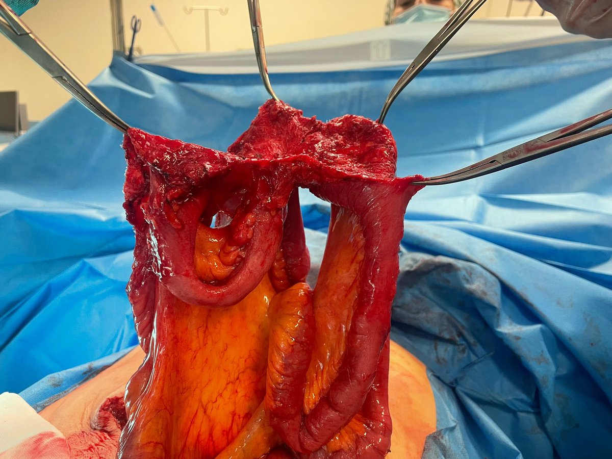 paredabdhuis's tweet photo. Mallas intraperitoneales. Otro de los muchos casos de mallas que “no se adhieren a las asas intestinales”. Un motivo más para explorar el abordaje extraperitoneal en la patología de la pared abdominal @AecPared @CirujanosMad @herniasrosario https://t.co/u9m2hrH76f