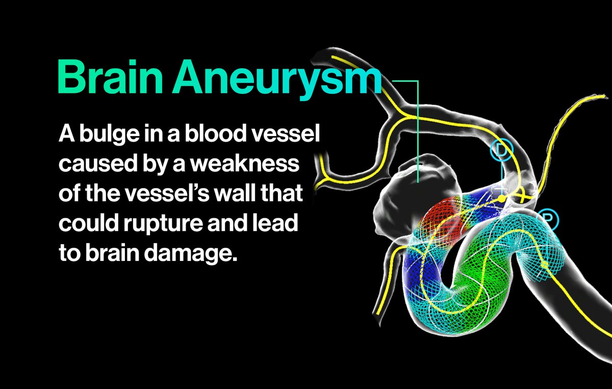 OxfordHeartbeat's tweet photo. Shockingly a brain aneurysm ruptures every 18 mins @BAFOUND (US)
#PreSize supports doctors with cutting-edge technology to best prepare for patient treatment before even starting surgery.
However, advancements mean nothing without greater awareness #BrainAneurysmAwarenessMonth https://t.co/SbrfAXF3IA