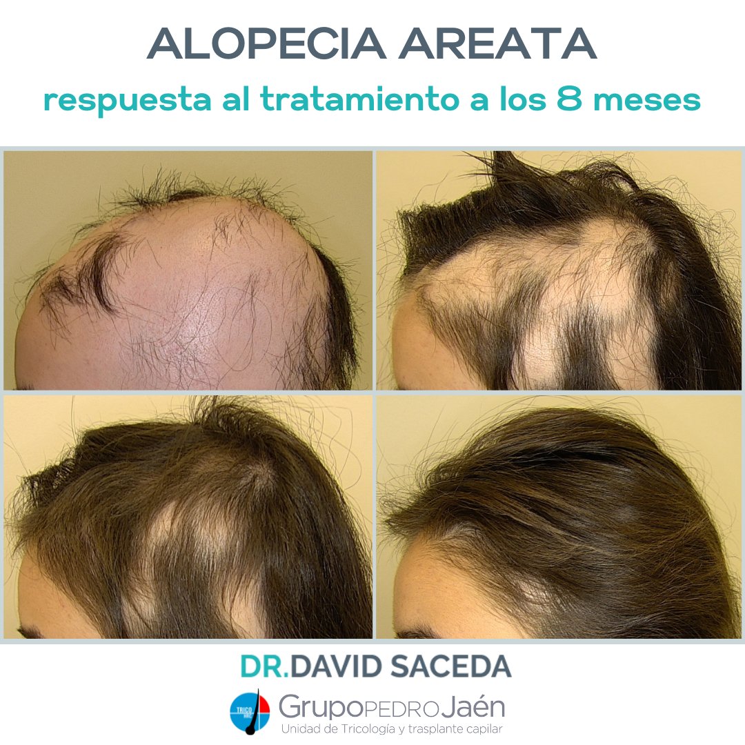 La alopecia areata total requiere un tratamiento sistémico (por vía oral, la mayoría de las veces) que necesita tiempo: 🗓 1. Imagen al inicio del tratamiento; 2. Recuperación inicial a los 3 meses; 3. Repoblación a los 6 meses; 4. Resultado final a los 9 meses. 👌🏼