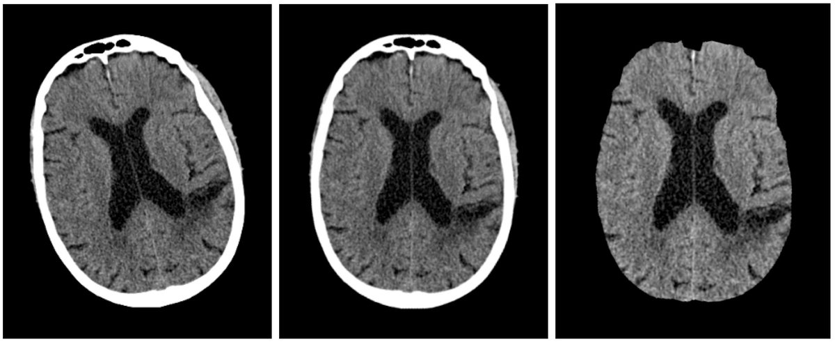 arlindooliveira's tweet photo. Our article, Using a Siamese Network to Accurately Detect Ischemic Stroke in Computed Tomography Scans, was just published by Springer, https://t.co/RrauRQ1epw #LUMLIS #MLKD https://t.co/XF1yeHGXt0