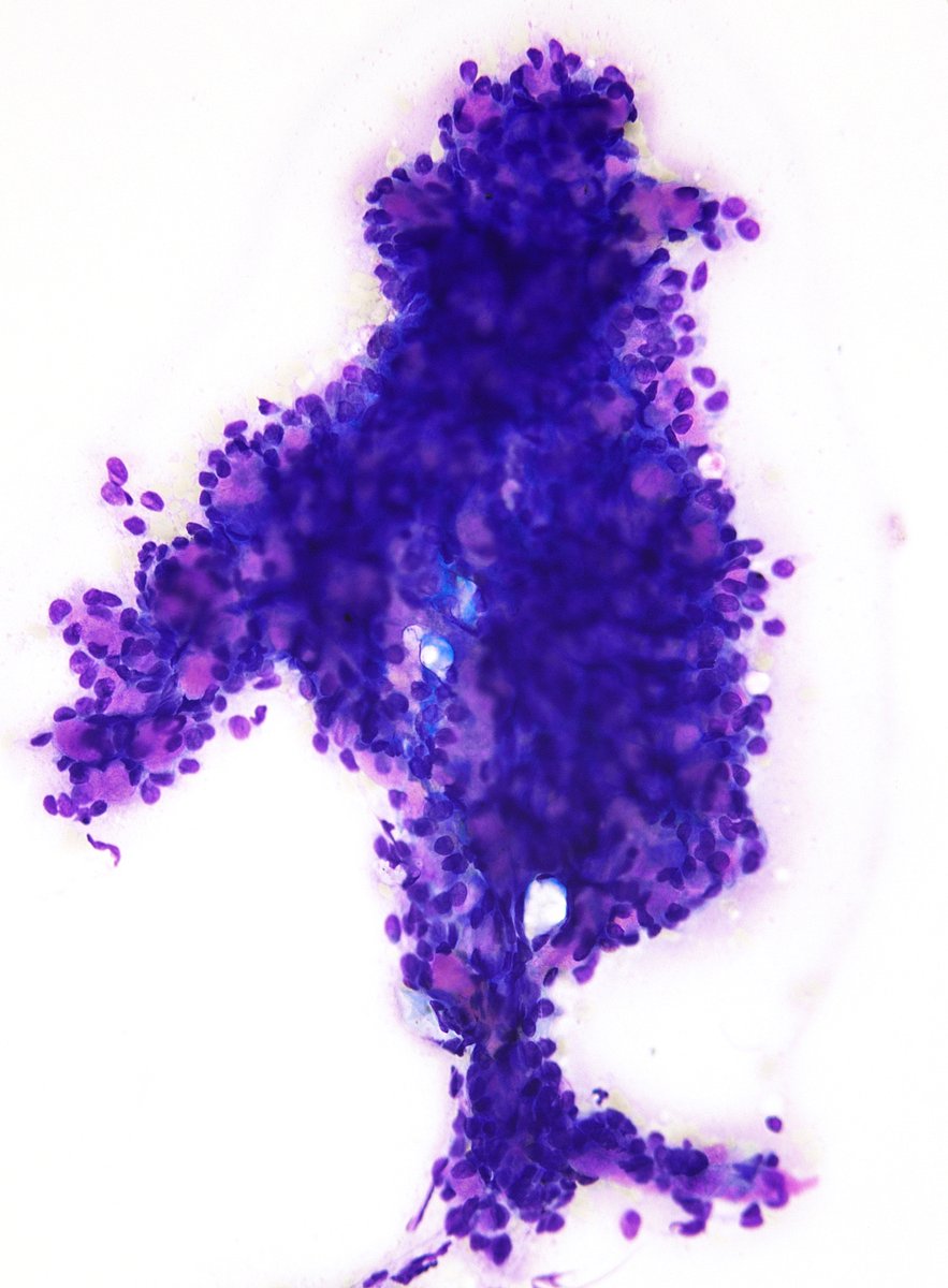 sza_jhcyto's tweet photo. An impressive and eye-catching "tree-like" tissue fragment from a Parotid "Pleomorphic Adenoma" displaying a "pseudo Adenoid Cystic CA-like" appearance. (FNA) https://t.co/5Hy7KrQg2w