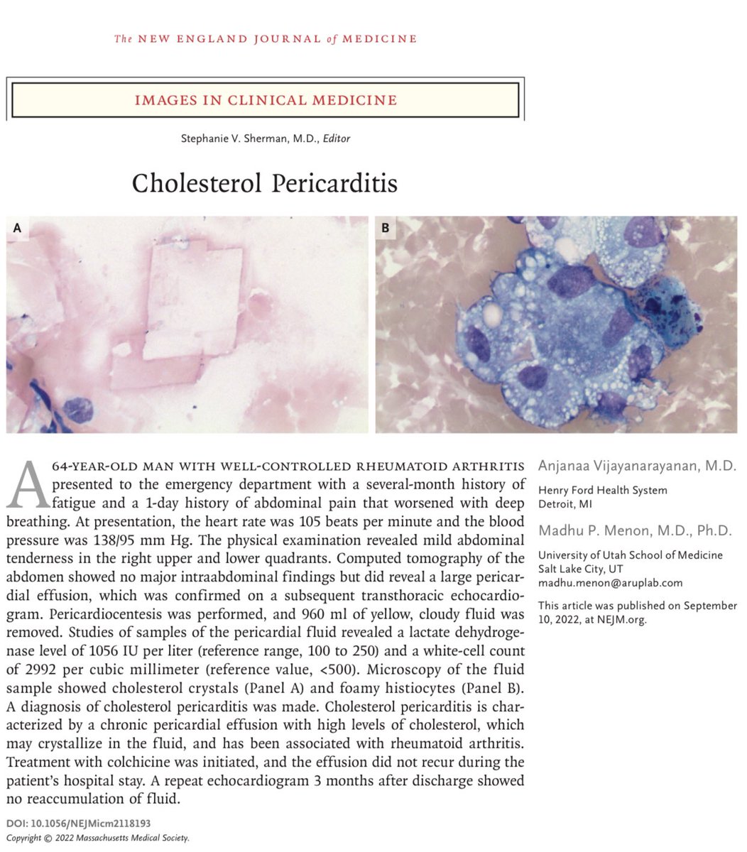 Mauricio ambriz on twitter pericarditis por colesterol n engl j med