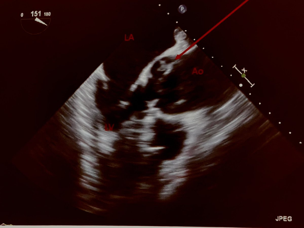 FOAMecmo's tweet photo. #POCUS &amp; #ECMO??
🖥 pre-ECMO assessment; identifying or confirming pathology, rule out complications, assist cannulation
🖥 intra-ECMO assessment: troubleshooting flows + evaluating readiness to wean from #ECLS
🖥 post-ECMO assessment
@adalia513 #ELSO2022 https://t.co/lMGIPVuPpk