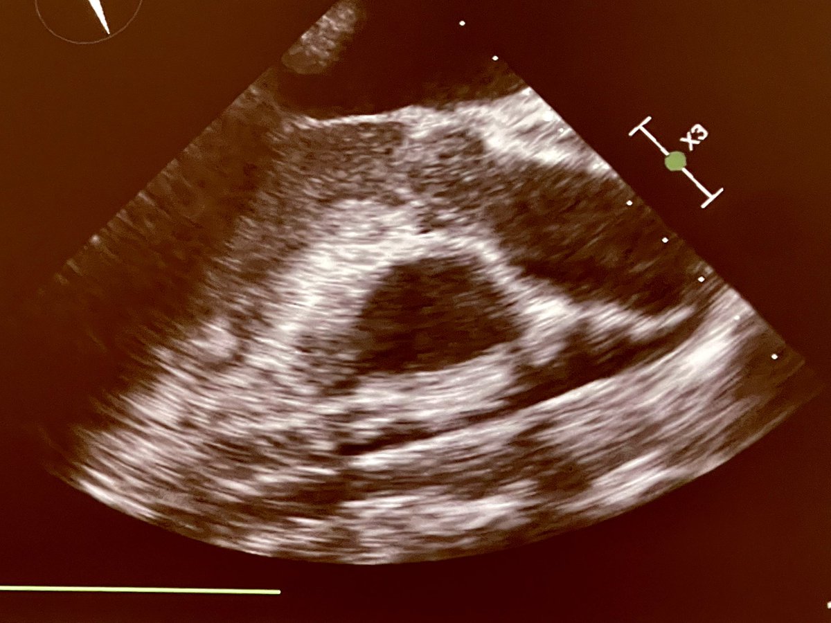 FOAMecmo's tweet photo. #POCUS &amp; #ECMO??
🖥 pre-ECMO assessment; identifying or confirming pathology, rule out complications, assist cannulation
🖥 intra-ECMO assessment: troubleshooting flows + evaluating readiness to wean from #ECLS
🖥 post-ECMO assessment
@adalia513 #ELSO2022 https://t.co/lMGIPVuPpk