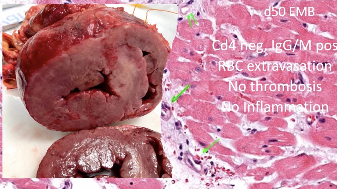 FOAMecmo's tweet photo. 🐖🫀 First Xeno-heart #transplantation in human: Bart Griffith at #ELSO202: biopsies never showed rejection: something virally related?? Viral RNA in heart capillaries: massive interstitial swelling + capillaries loss = lost perfusion = lost contraction. Roles of IVIG, pCMV, AMR? https://t.co/uZk7a1NlV1