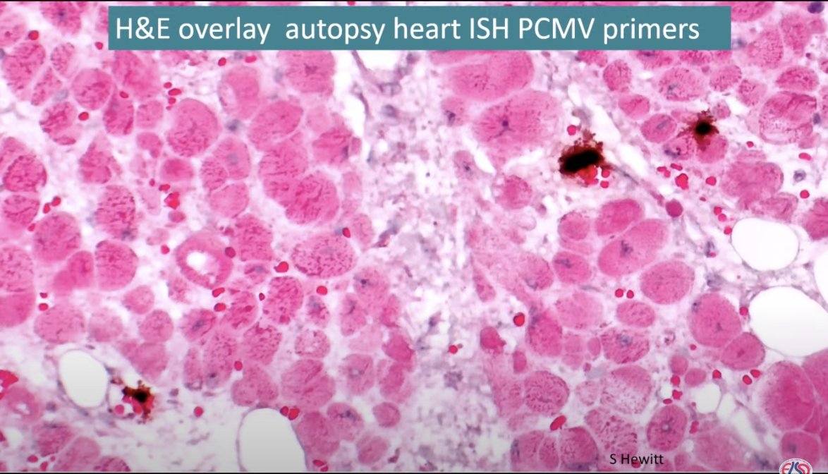 🐖🫀 First Xeno-heart #transplantation in human: Bart Griffith at #ELSO202: biopsies never showed rejection: something virally related?? Viral RNA in heart capillaries: massive interstitial swelling + capillaries loss = lost perfusion = lost contraction. Roles of IVIG, pCMV, AMR?