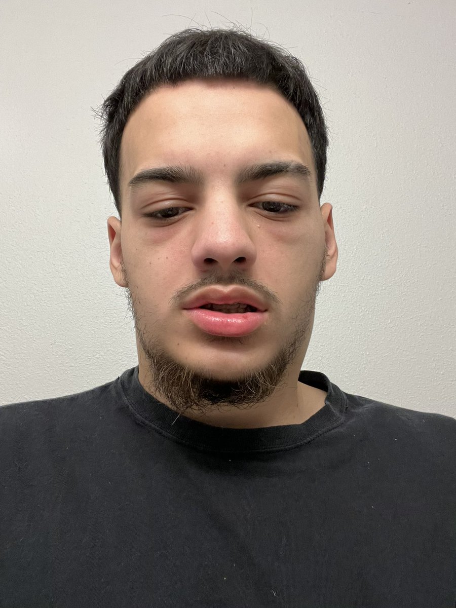 D3 🙇🏽 On Twitter Day 2 After Steroids I Cant Feel My Face Nor My Cock