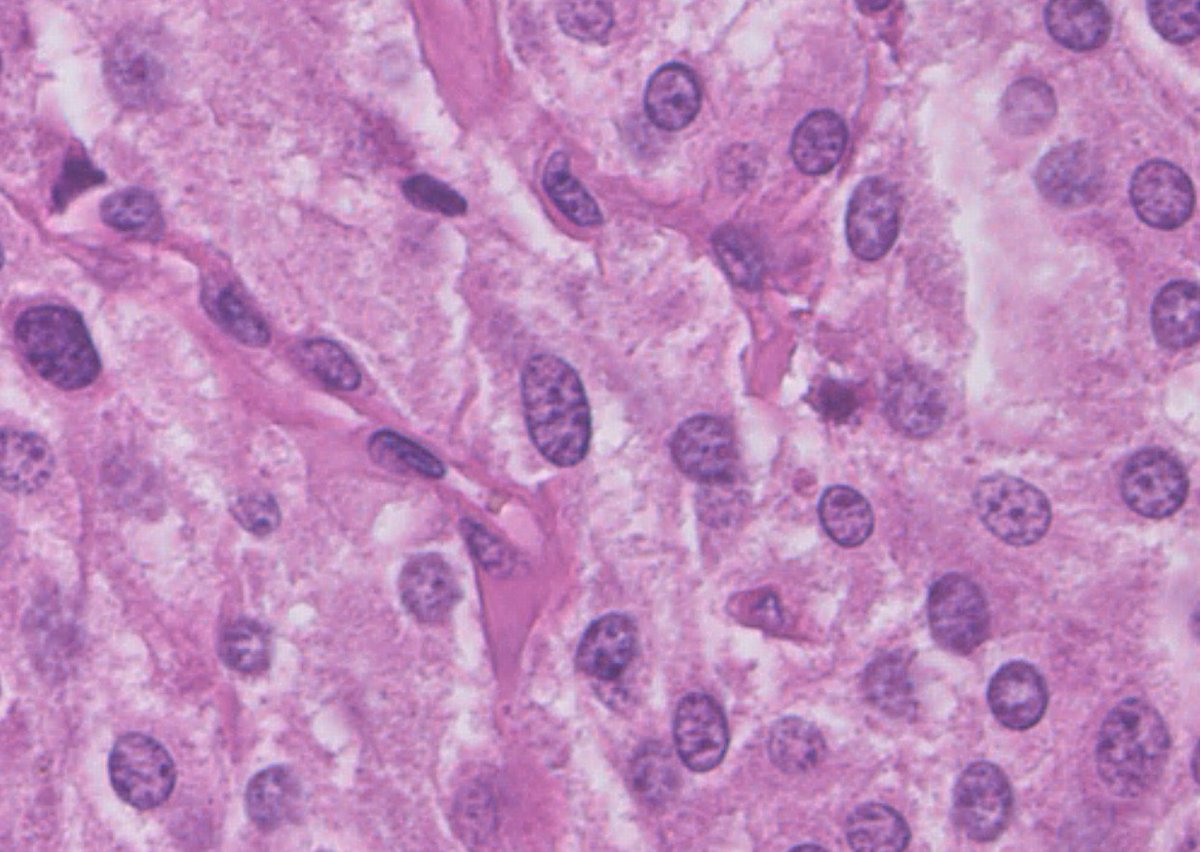 Woman, 28 yo. Vaginal nodule.
What do you think?

#pathology #PathTwitter