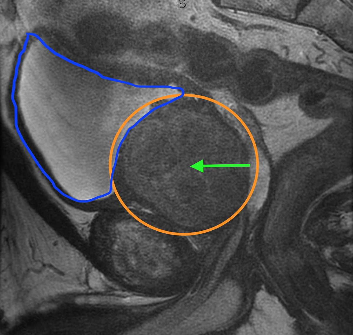 thefibroidlady's tweet photo. MRI of an enlarged #prostate (orange) from benign prostatic hyperplasia #BPH. Urine should empty freely from the bladder (blue) through a patent urethra except the prostate obliterates that channel (green arrow)! Men have options and some choose prostate artery embolization #PAE. https://t.co/8n7LiIpkwf