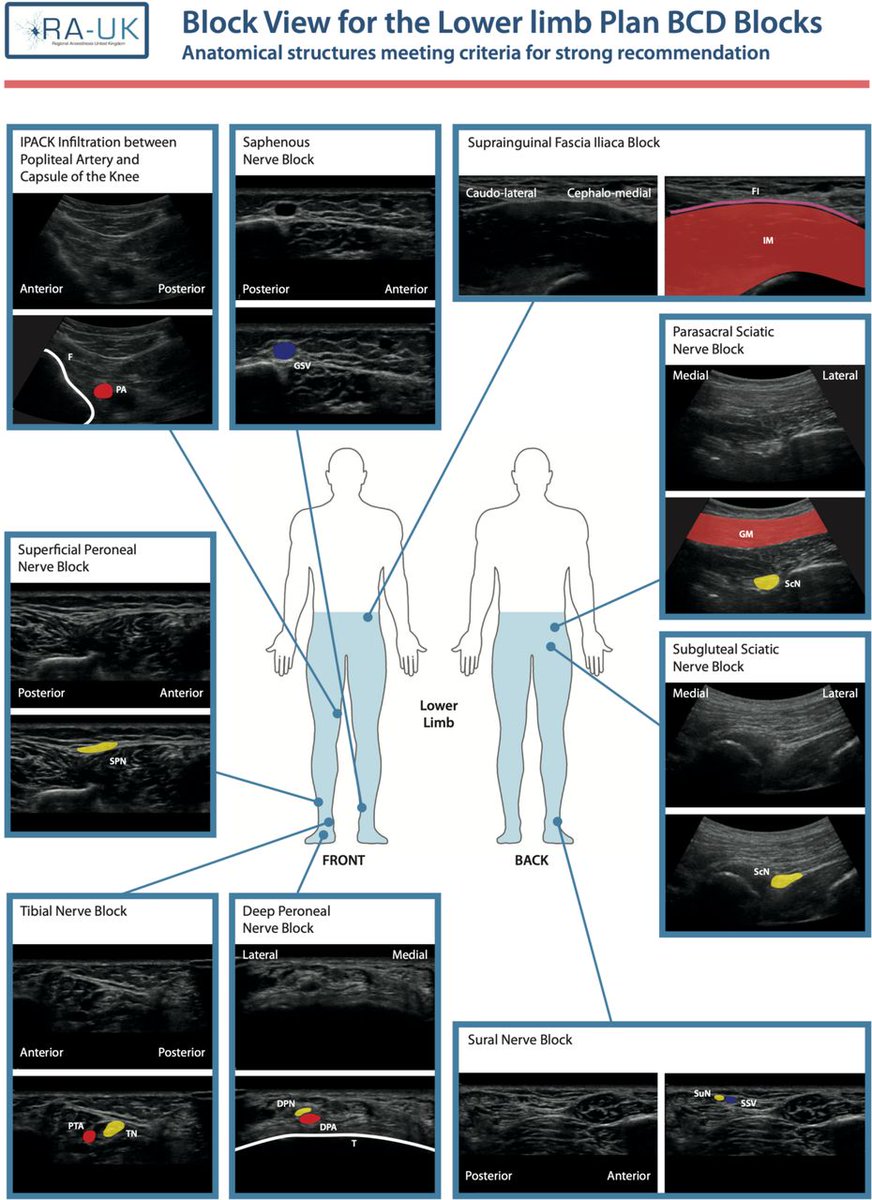 RAPMOnline's tweet photo. Recommendations for anatomical structures to identify on ultrasound for the performance of intermediate and advanced blocks in ultrasound-guided regional anesthesia

https://t.co/bUsjLZ9n8P

@bowness_james @ajrmacfarlane @womackjonathan @amit_pawa
@ESchwenkMD @dr_rajgupta https://t.co/lqku6AppEp