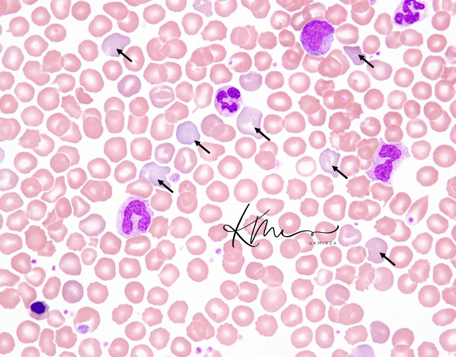 Ever wondered why #reticulocytes are blue-gray on the Wright smear? Residual RNA in the cytoplasm causes this color! Referred to as polychromatophilic red cells, they are 'closer' to having had a nucleus and residual RNA (which stains blue!) #DailyHemepath #leusm #pathology
