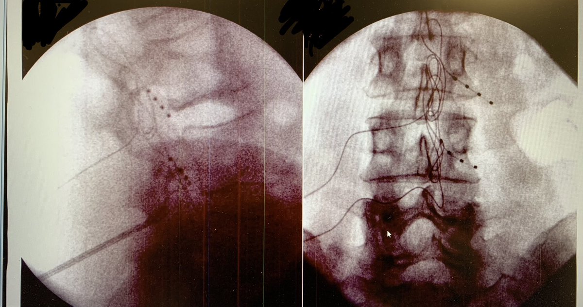 jonmichaelsr's tweet photo. This patient was one year out from right TKA that left them with 50 degs of knee ROM and constant pain. Now, two months s/p right L3 and L4 DRG-S, and they have 95 degs of knee ROM and >50% pain improvement. Success! #neuromodulation #drgstimulation https://t.co/UYSJb4Lqkt
