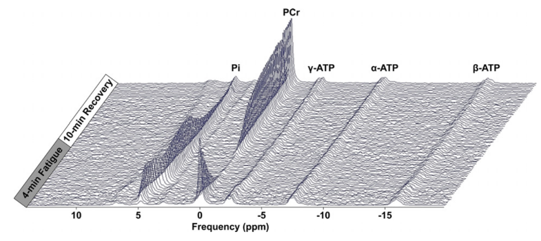 In their 2019 paper, Jaber et al. created this awesome(!) 3D graph showing how ATP, phosphate (Pi), and phosphocreatine (PCr) levels change during exercise. Understanding these metabolites is one of the goals of our exercise research #osidccasestudy pubmed.ncbi.nlm.nih.gov/32140702/