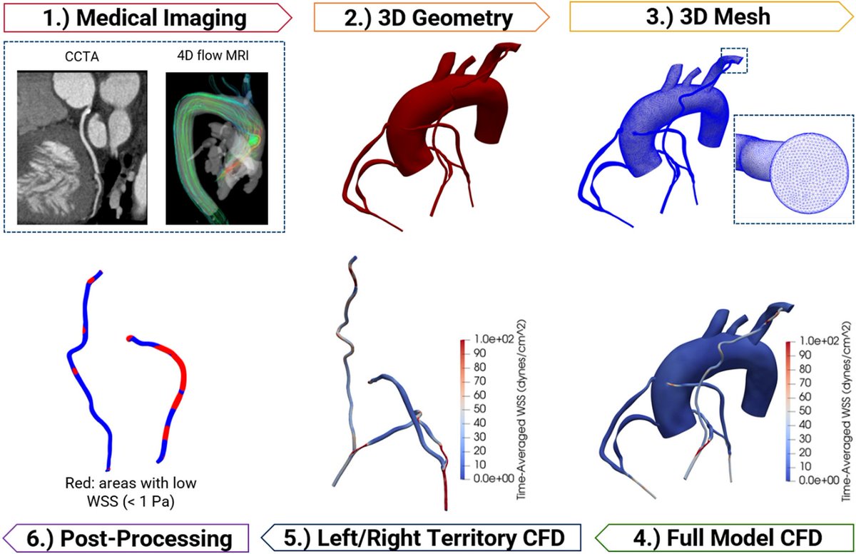 Nhien's study is the first of its kind to prospectively reveal differences in abnormal WSS area 1 month post surgery among bypass grafts of different type. Thanks <a href="/RSNA/">RSNA</a> <a href="/bme_uoft/">Biomedical Engineering @ University of Toronto</a> <a href="/eceuoft/">ECE U of T</a> @uoftengineering <a href="/UofT/">University of Toronto</a> <a href="/Sunnybrook/">Sunnybrook Health Sciences Centre</a> <a href="/Alliance_Can/">The Alliance | L’Alliance</a>. <a href="/LJimenezJuan/">Laura Jimenez Juan</a> 

link.springer.com/article/10.100…