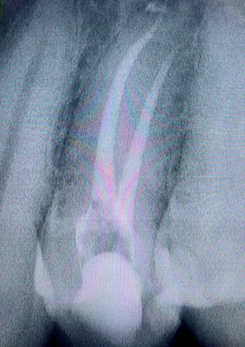 drpmdfuentes's tweet photo. Paciente con #dolor por foco de #infeccion en #pieza24 Se realiza #tratamiento en @clinicaselolivo de #reendodoncia #birradicular con #ahplusbioceramicsealer y #limas #protaperultimate ¡Paciente sin dolor, Dentista contento! 🦷😎 #FelizJueves #HappyThursday #dentistrylove https://t.co/JDZTi3j3IA
