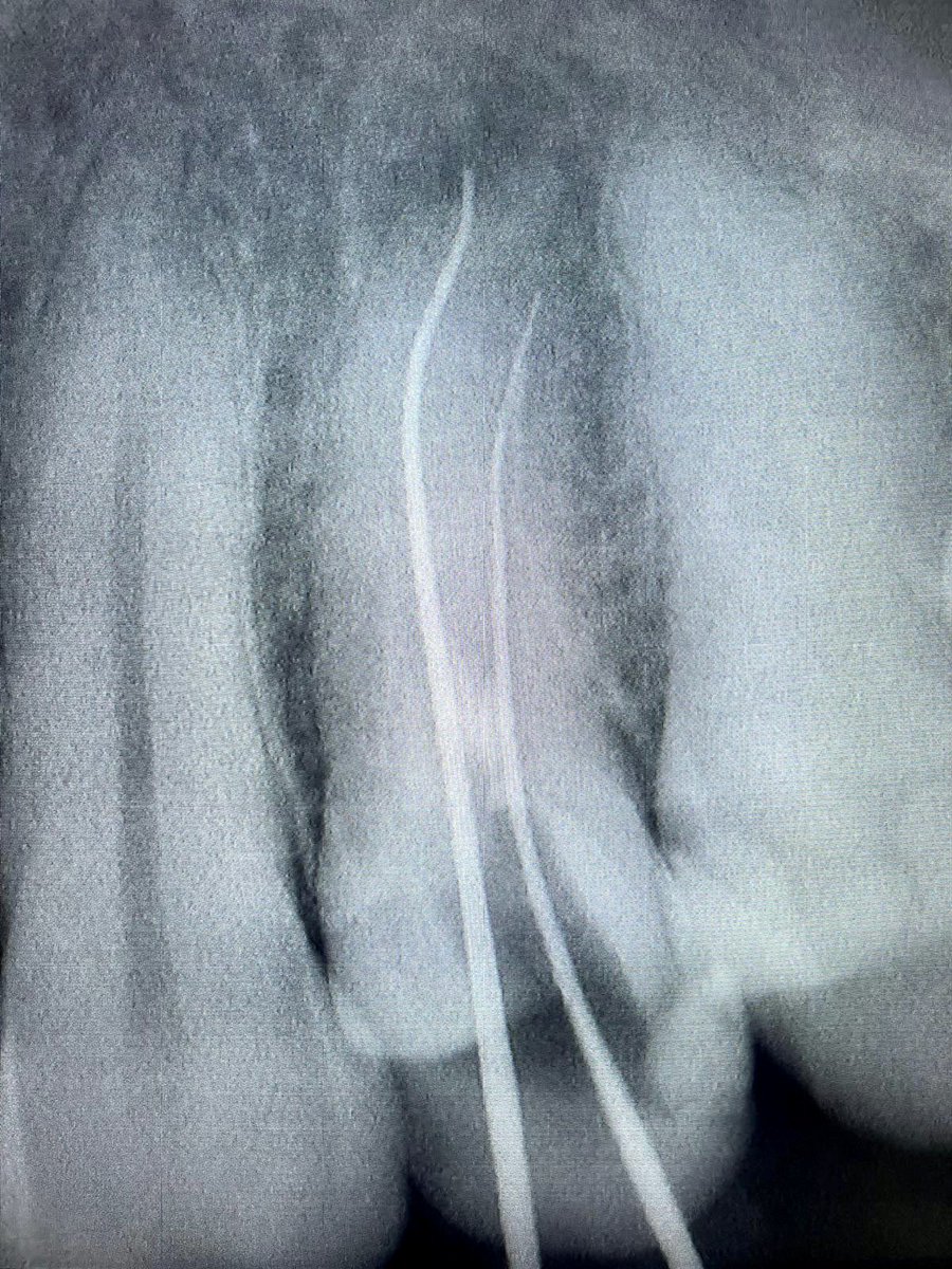 drpmdfuentes's tweet photo. Paciente con #dolor por foco de #infeccion en #pieza24 Se realiza #tratamiento en @clinicaselolivo de #reendodoncia #birradicular con #ahplusbioceramicsealer y #limas #protaperultimate ¡Paciente sin dolor, Dentista contento! 🦷😎 #FelizJueves #HappyThursday #dentistrylove https://t.co/JDZTi3j3IA