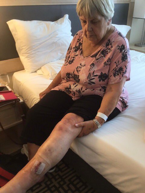 ConsumerSOS's tweet image. Liz Scanlon tweeted me this morning. I have her story tonight. Her mom, pushed in a wheelchair by an @AirCanada employee at @TorontoPearson, had her leg rammed into a metal detector. Seven stitches. Then her walker didn’t arrive in Lisbon. We are on it. #IWorkFortheViewer