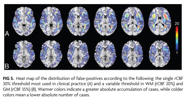 AJNR (@theajnr) on Twitter photo "Optimizing the Definition of Ischemic Core in CT Perfusion: Influence of Infarct Growth and Tissue-Specific Thresholds" #Stroke #Ischemia #OpenAccess <a href="/IctusClinic/">Ictus Clinic</a> <a href="/xabierurra/">Xabier Urra</a> | bit.ly/3eUC6Gr "Optimizing the Definition of Ischemic Core in CT Perfusion: Influence of Infarct Growth and Tissue-Specific Thresholds" #Stroke #Ischemia #OpenAccess <a href="/IctusClinic/">Ictus Clinic</a> <a href="/xabierurra/">Xabier Urra</a> | bit.ly/3eUC6Gr