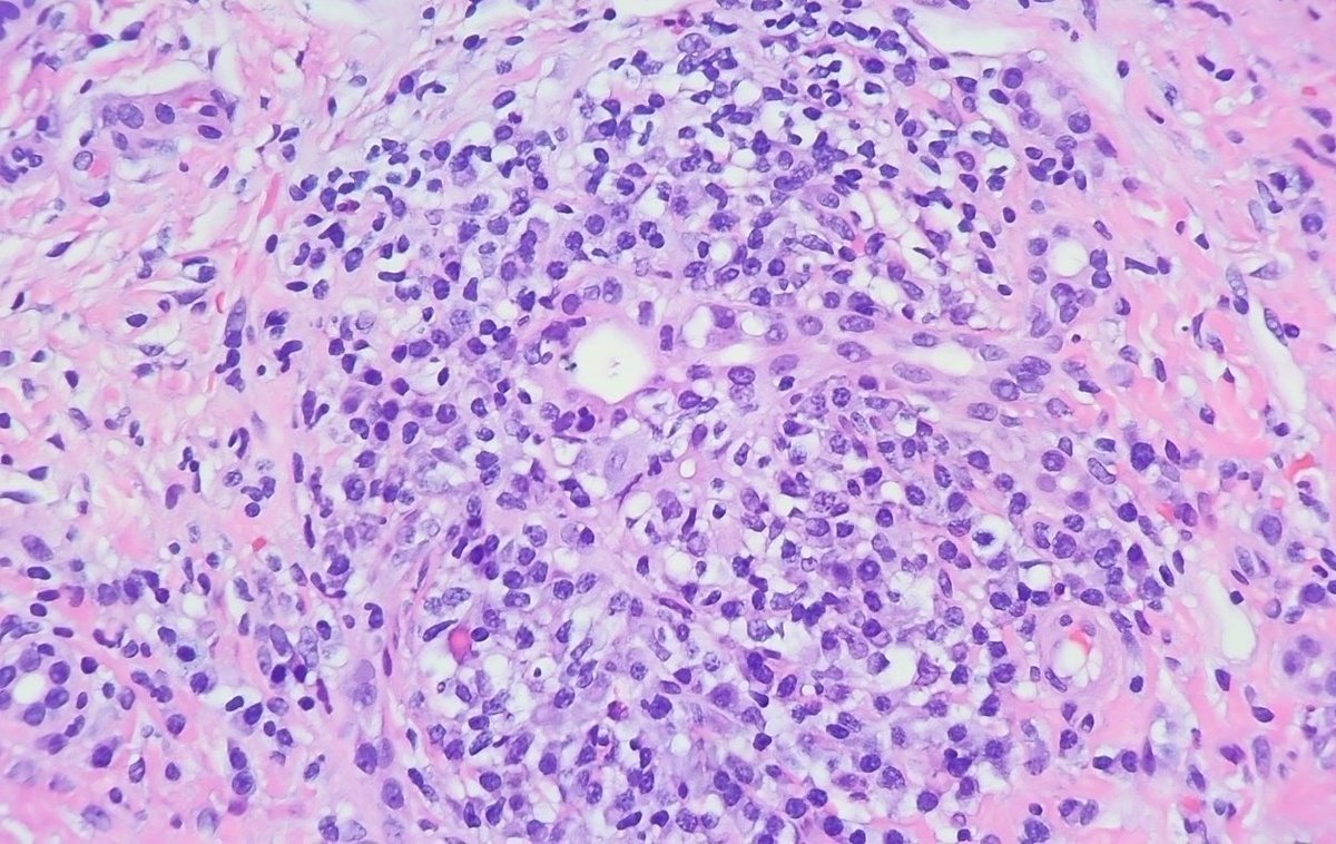 Tell us your thoughts 💭🧐

#pathology #GIpath #pathresidents