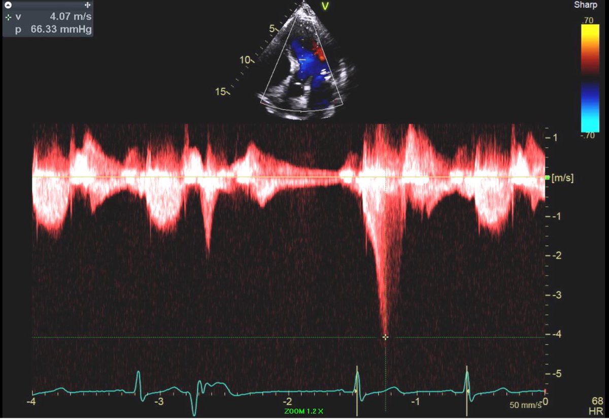 Zero to 60 in a single heart beat: Notice the power of Post-Extra Systolic Potentiation! @pattypellikka @MasriAhmadMD @jeffreygeske @CSHeartResearch @dr_benoy_n_shah @KyleWKlarich @renujain19 @purviparwani @echo_stepbystep @VLSorrellImages @ChamsiPash