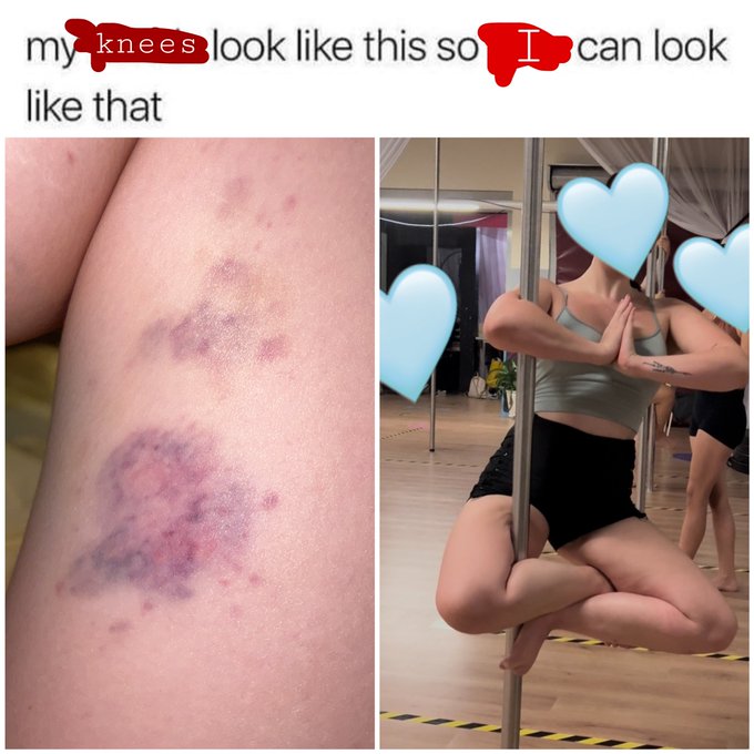 this is my pain management   (The pain isn&rsquo;t that bad) https://t.co/40TEN9q9ZC<a href="/tag/perfecteplaatje"class="tags"><span>#perfecteplaatje</span></a>