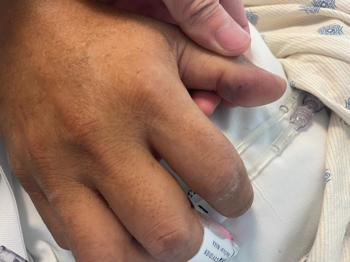 UTHealthSA_ID's tweet photo. #IDtwitter #medID #meded 

Check out these cool Osler's nodes on a Staph aureus endocarditis patient! 

Typically these immunologic phenomena are seen in subacute endocarditis like viridans grp Strep, but can also be seen in acute IE! https://t.co/Iq7reVqTVl