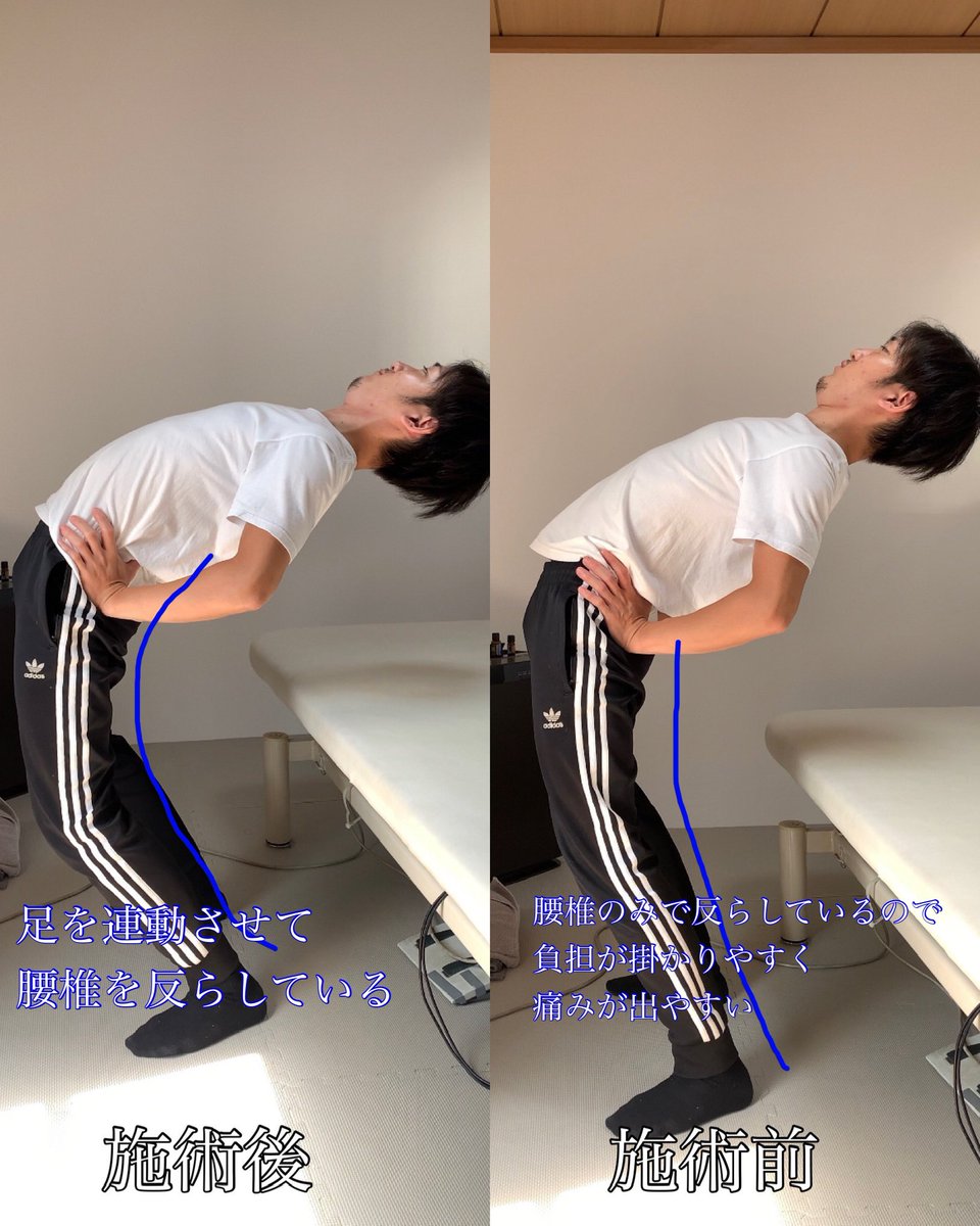 bluetreeeeeee53's tweet photo. ⭕️腰を反らすと腰が痛い！
⭕️仰向けで寝るとしんどい

今回は腰椎（腰の骨）と
足の動きを利用して
腰椎の伸展（反らす動き）を促しました。

腰反る時に下半身も使う意識大事！😁

#腰痛 #肩こり https://t.co/n9achn2dOf