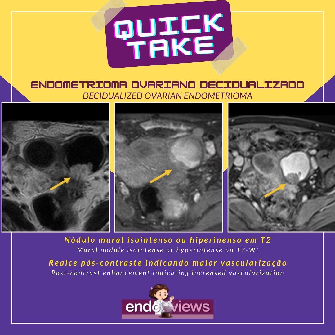 endoviews's tweet photo. Endometrioma ovariano decidualizado
Decidualized ovarian endometrioma
Dra. Luciana Chamié - @lucianachamiec1
Dra. Izabela Pires Franco - @izabelapfranco
Dra. Alice Brandão
🔮Endoviews. O seu banco de imagem em endometriose.
🔮Endoviews. Your image database on endometriosis. https://t.co/dd5D3kVM69