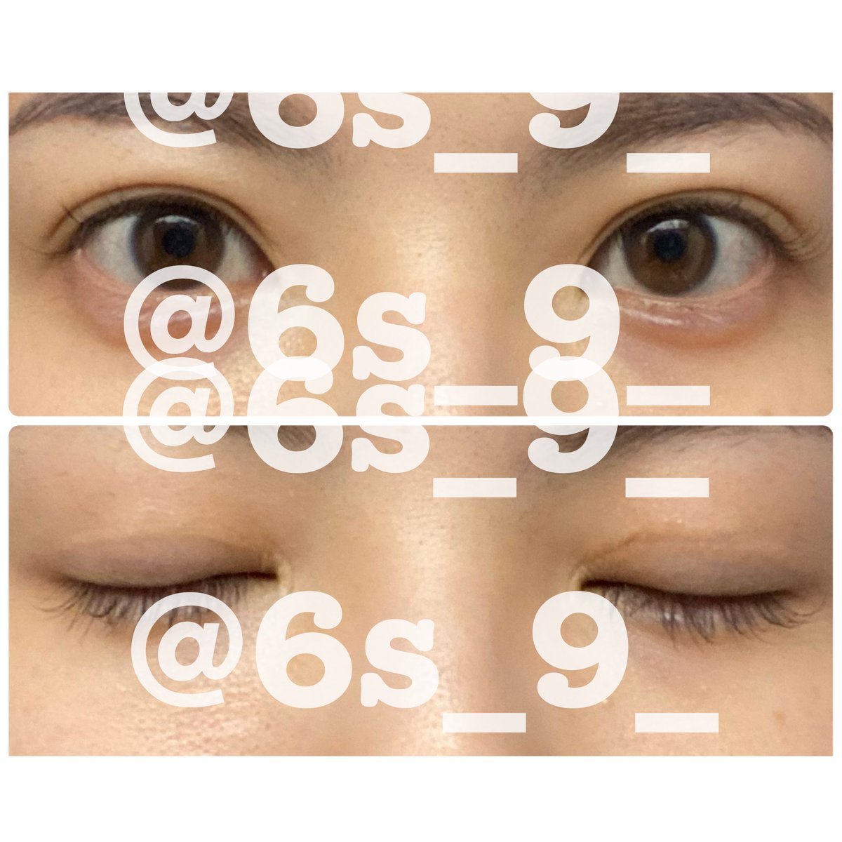 6s_9_'s tweet photo. 二重切開修正(何回目？)
3ヶ月検診おわった。
伏し目とか閉じた傷跡はやっぱり気になるけど
とりあえず様子見かなあ https://t.co/06oIT1DqP5