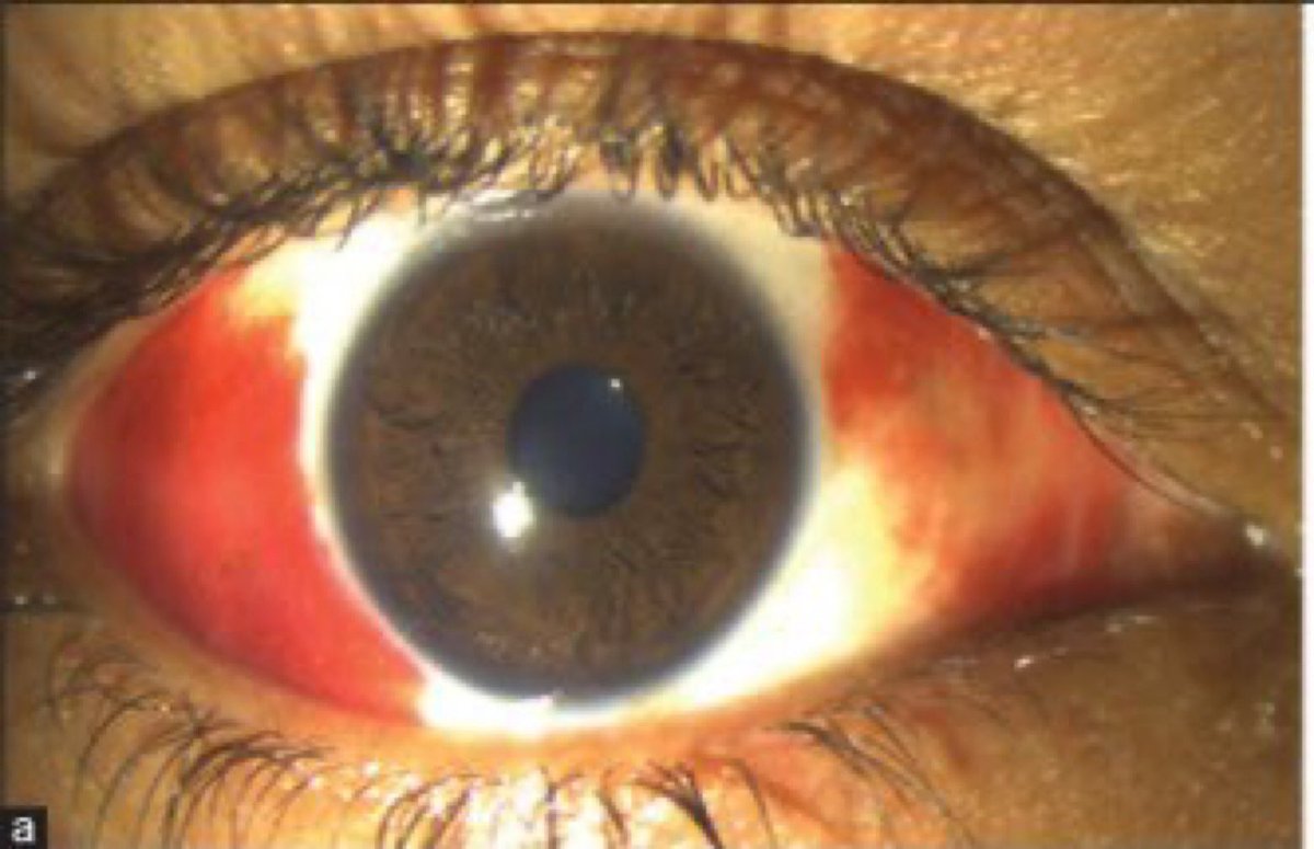 Nigelj08223326's tweet photo. @juridr2 
@SamRoberts4 
@AdrianKennedy 
@dr_ianjackson 
@drjohnmorley 
@MyatThi28104092 
@maybradford 

A patient presented with bilateral red eyes, fever, and vomiting

Diagnosis = leptospirosis #Weils spread by Rat urine

Saw many cases in Trinidad 🇹🇹🐭 https://t.co/CCFC8xQCqn