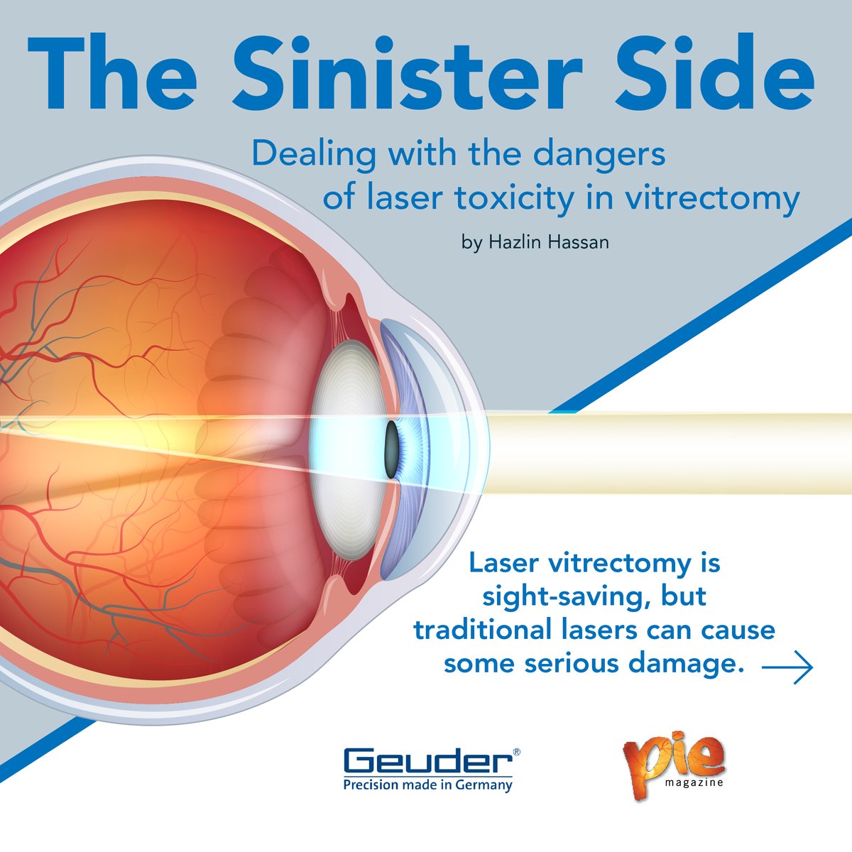 MediaMICEgroup's tweet photo. Laser vitrectomies are blades of light that can save your sight — but there’s a double edge!
Read our newest write up to find out how!
https://t.co/Dm9hweNyM3
#Geuder #SOLEALED #MediaMICE #PIEmagazine #eyesurgery #ophthalmology https://t.co/0K9OhgRqUr